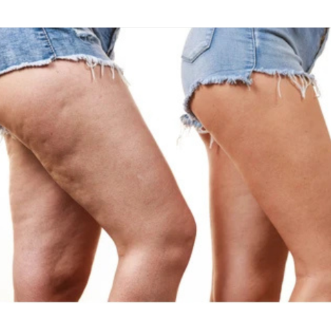 Aceite anti-celulitis - Reduce la celulitis hasta en un 68 %, mejora la textura y elasticidad corporal - ¡Gran promo!
